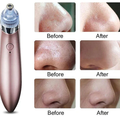 Multi-Functional Blackhead Whitehead Remover